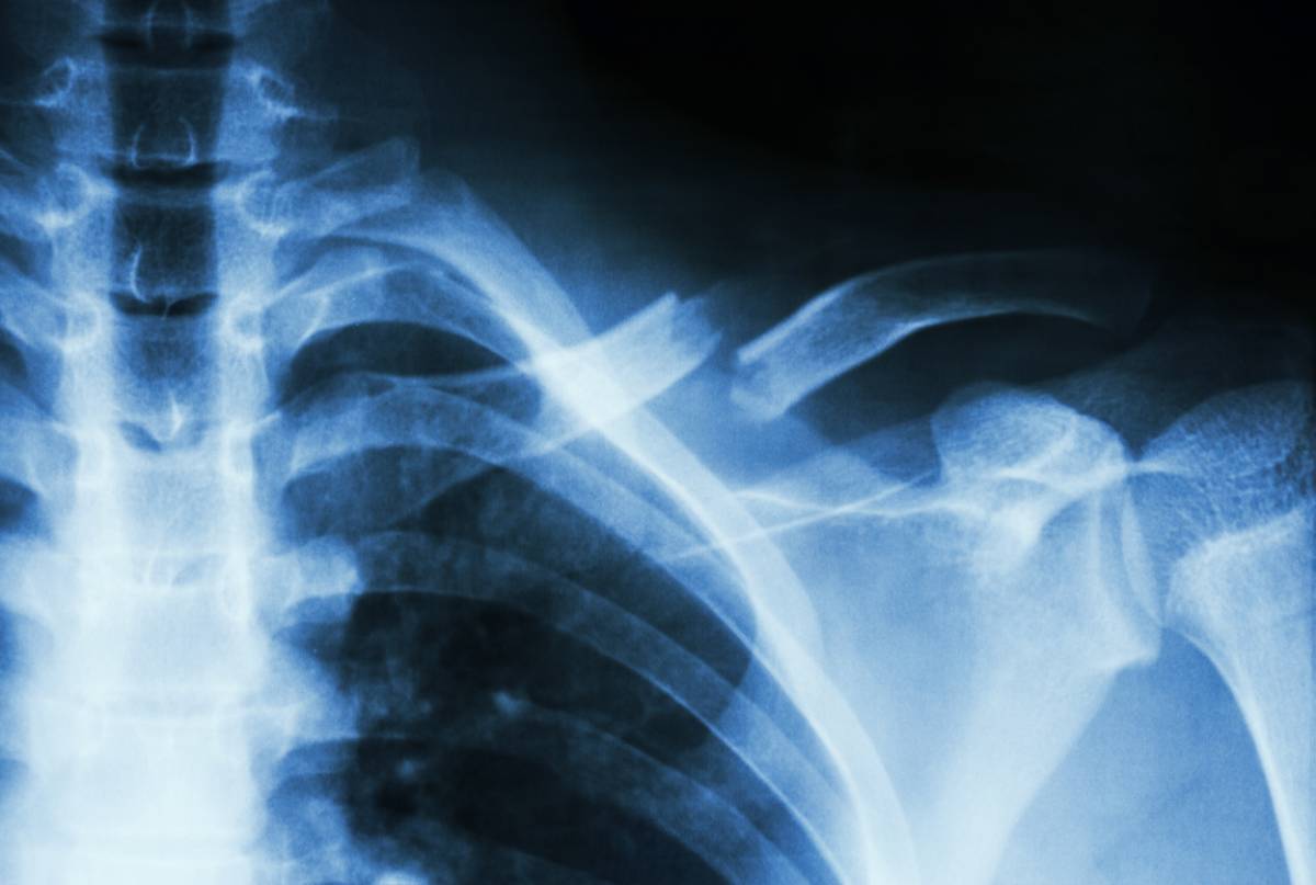 Anesthesia for a Broken Collarbone 