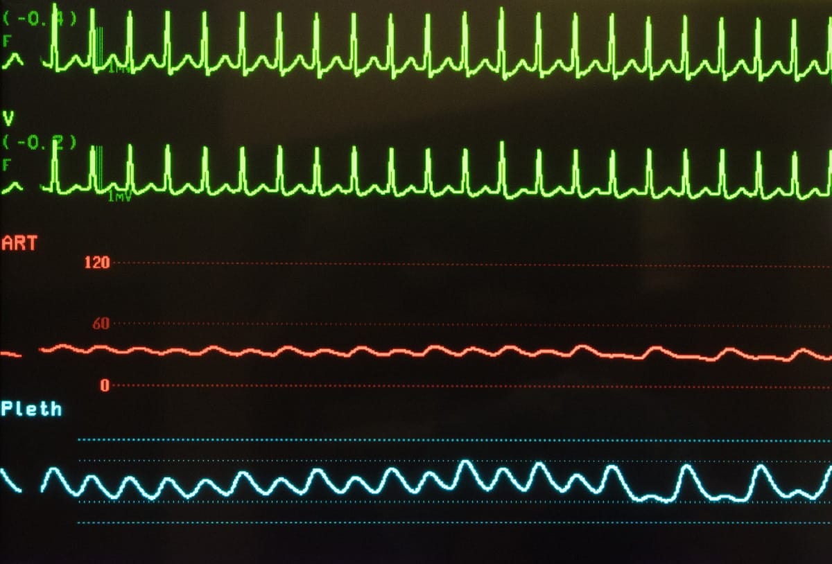 Causes of Tachycardia