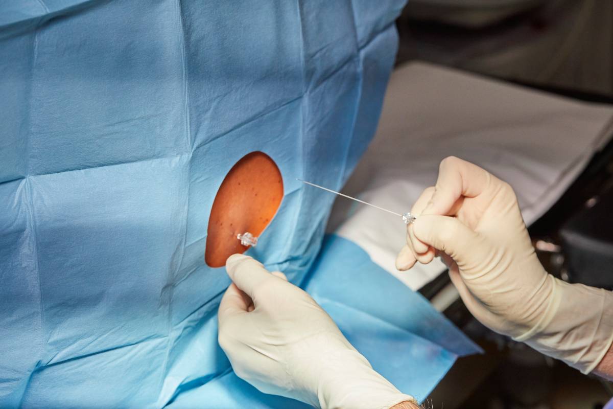 Dural Puncture Epidural Technique 