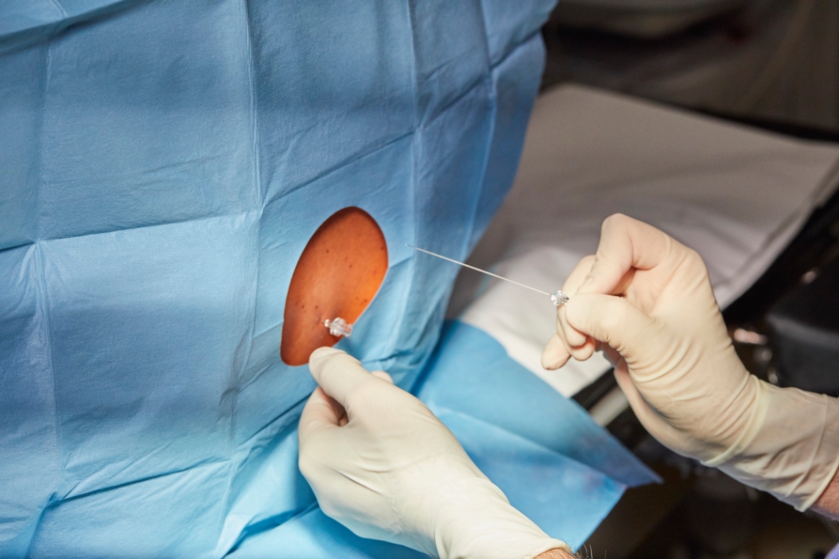 Effectiveness of Prolonged Epidural Catheter Use