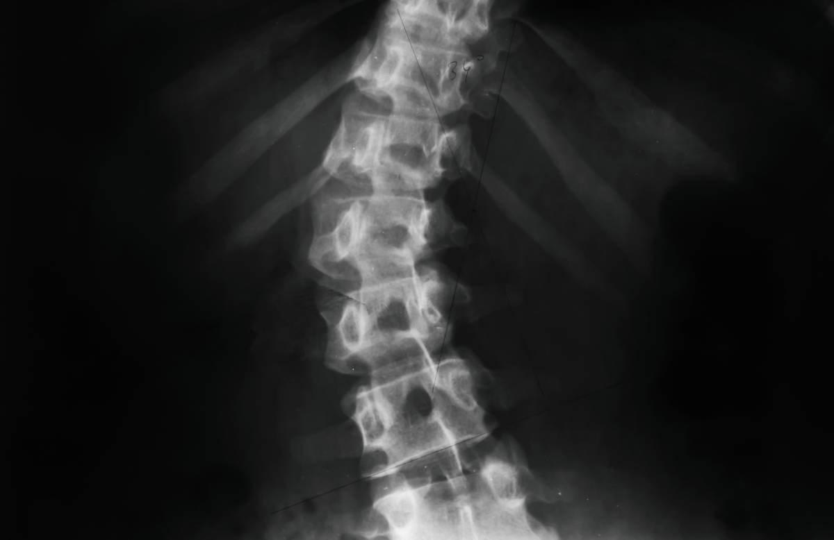 Neuraxial Anesthesia in Patients with Scoliosis