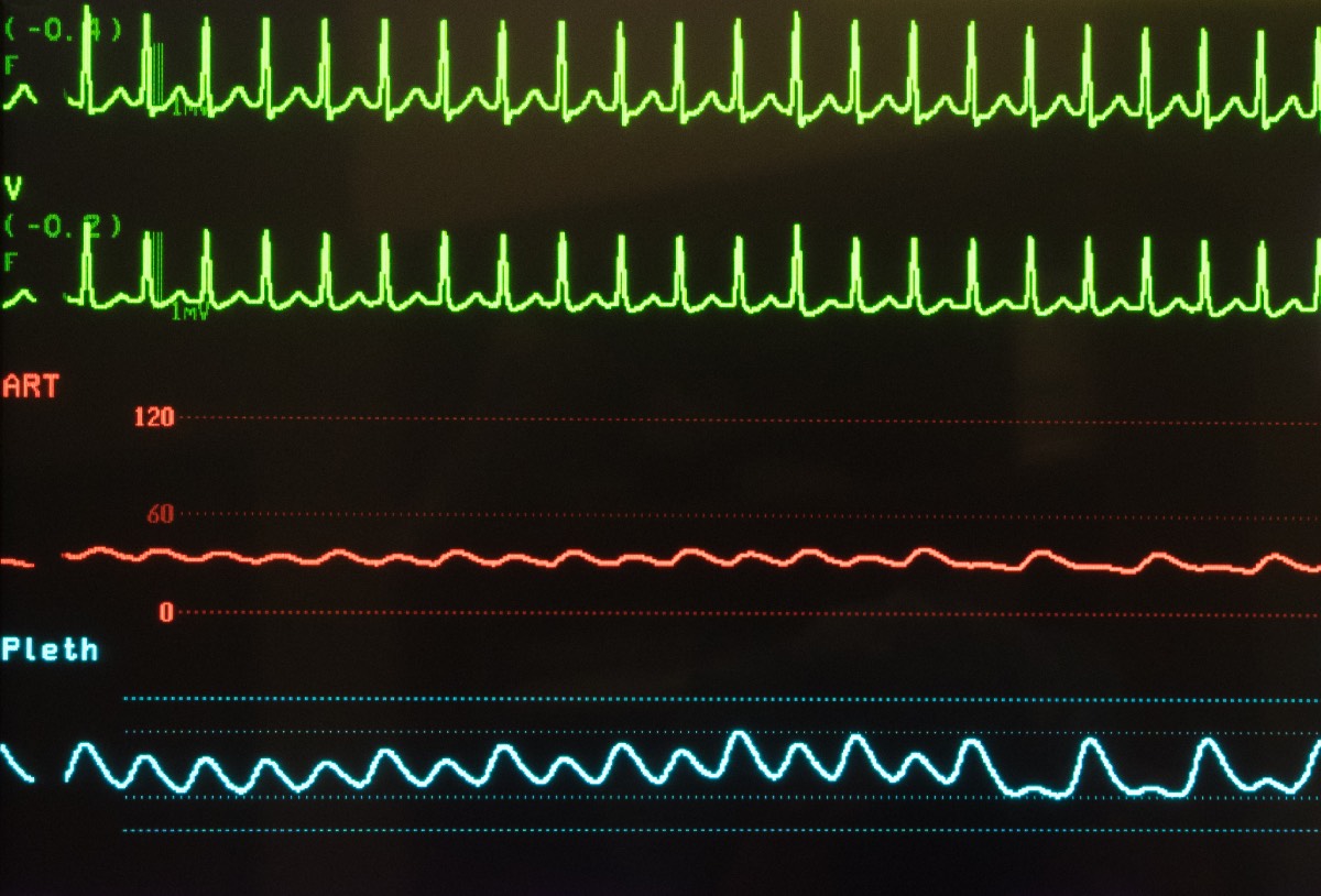 Causes of Tachycardia